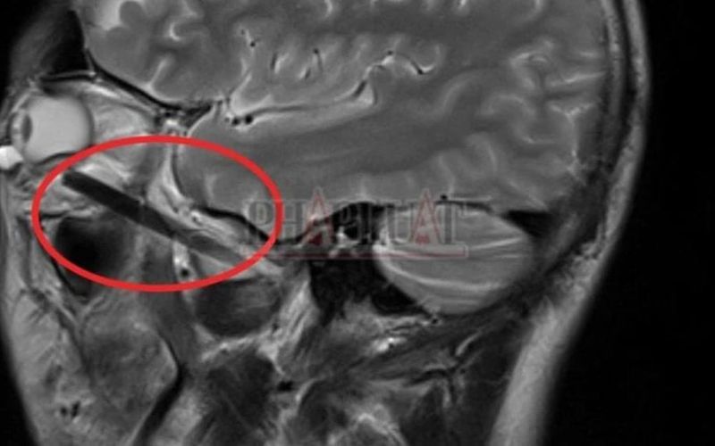 Chuyện lạ: Bị chiếc đũa đâm sâu trong hốc mắt mà không biết