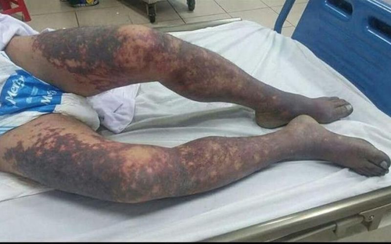 Hà Nội ghi nhận ca mắc liên cầu lợn đầu tiên năm 2024